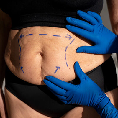 Abdominoplastia Abdominoplastia.jpg