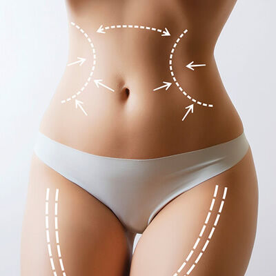 Lipoaspiração Lipoaspiração.jpg